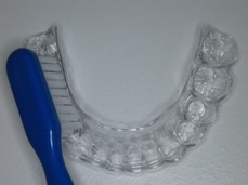 Orthodontic invisible retainer 3