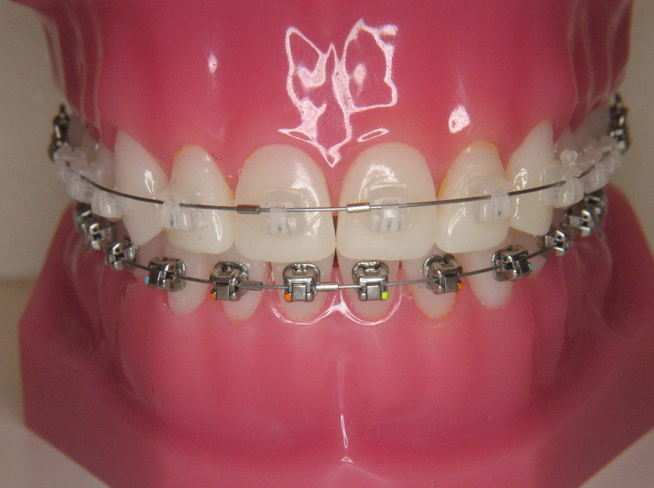 De brackets - Orthodontiepraktijk