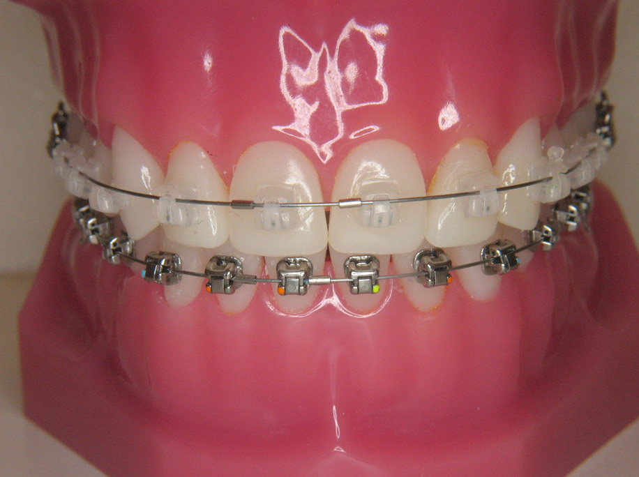 prinses verkouden worden Dank u voor uw hulp De brackets - Orthodontiepraktijk Wilhelminapark