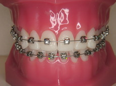 zelfligerende metalen brackets in de onder  en bovenkaak